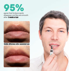 Abera Fordyce Cream being applied on lips for daily lip care routine.