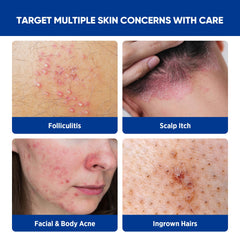 AOSORW scalp-use image shows targeted care for irritated follicles.