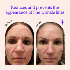 BLUMBODY forehead patch on skin highlights non-silicone, comfortable wear for forehead lines.