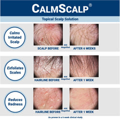 CalmScalp serum being applied along the hairline for relief from itching.