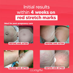 cicatrissim red stretch cream texture close-up shows quick absorption and smooth skin