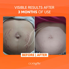 Cicatrissim stretch mark cream being massaged into the abdomen area