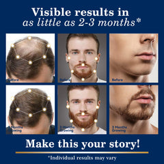 DAAZZS Minoxidil scalp closeup showing thinning areas