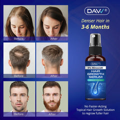 DAVV Minoxidil spray applied to the scalp for targeted growth.