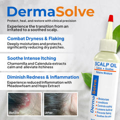Dermasolve scalp oil dropper in hand for easy targeted application.