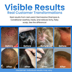 Dermasolve shampoo lather ready for easy application on sensitive scalps