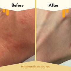 ECZEMA HONEY Oatmeal Body Lotion hand-application demonstrates gentle daily care.