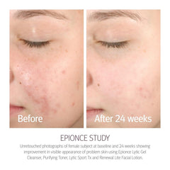 Epionce Renewal Lite application on face demonstrates quick-absorbing hydration.