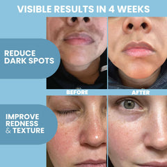 Eva Naturals azelaic serum niacinamide image shows clear tone benefits.