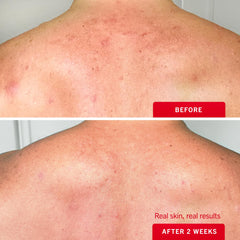 First Aid Beauty Body Acne Spray butt-area coverage reaches hard-to-reach zones.