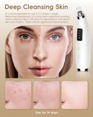 Flymooo suction level options for gentle to powerful skin care
