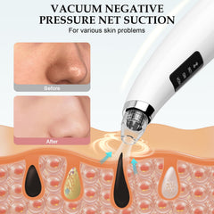 FLYMOOO Facial Pore Vacuum probes-pack with 5 stainless tips for precision