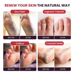 Foot Cure Softens calluses for smoother feet after use.