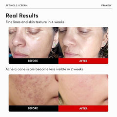 FRANKLY retinol application on skin demonstrates beginner-friendly care.