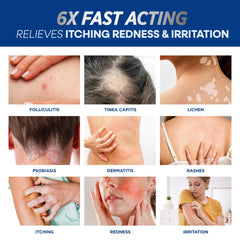Hermon Folliculitis Cream on scalp demonstrates soothing relief during daily routine.