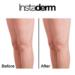 Instaderm Vitamin K Cream for under-eye circles reduces puffiness and dark shadows.