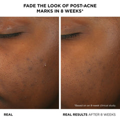IT Cosmetics Bye Bye Breakout Serum droplet application shows precise dosing for daily spot and all-over use.