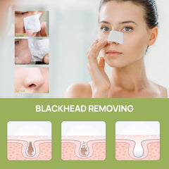 LANBENA nose pore close-up shows targeted cleansing effect.