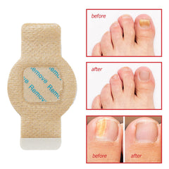 LTQXGT fungal nail patches open pack: easy at-home use and clean application