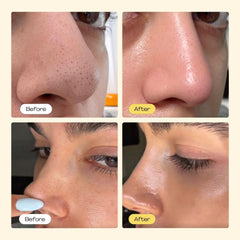 Luelle Pore Strips on forehead and cheeks for a clearer look