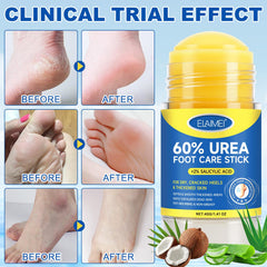Mcukv Urea Cream Stick used at night with socks for deeper repair