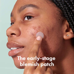 Mighty Patch Micropoint Large patch on blemish demonstrates discreet, breathable coverage