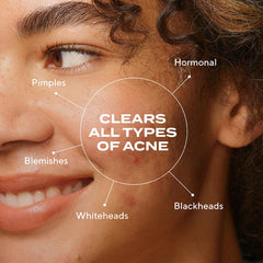 Murad Biome-Balancing Acne Serum dropper for precise, gentle application.