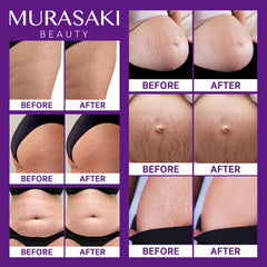 Murasaki Beauty stretch-mark cream hyaluronic acid emphasis for hydration