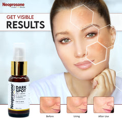 Neoprosone crema-mancha-codos: reducción visual de manchas en codos ásperos.
