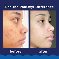 Using PanOxyl on back and chest to treat body breakouts effectively