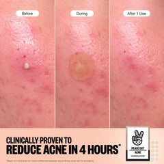 PEACE OUT Acne Healing Dots on-face at night demonstrates overnight blemish support.