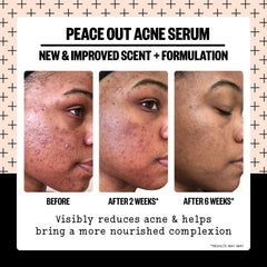 Peace Out Acne Serum swirls on skin showing lightweight, non-greasy hydration