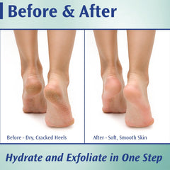 Pedifix foot-care dry-heel hydration application demonstrates daily moisture routine for cracked heels.
