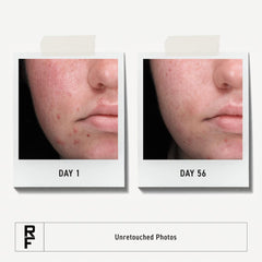 Rodan + Fields Spotless Daily Acne Wash foaming lather provides deep cleansing to help prevent breakouts.