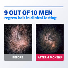 Rogaine foam applied to scalp demonstrating targeted coverage benefit