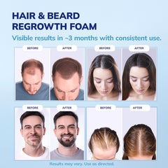 RootStim Minoxidil Foam close-up demonstrates lightweight texture ideal for scalp application