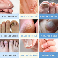 Scientific Solutions Global Urea 50 Nail Gel toenails before image highlighting thick surface