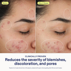 Skinfix 2% BHA Cleanser ingredients-glycolic-acid smooths texture for clearer skin.