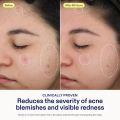 Skinfix azelaic-acid formula reduces redness for even tone