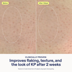 Skinfix KP + PsO Smoothing ingredients label highlights glycolic, lactic, and salicylic acids.