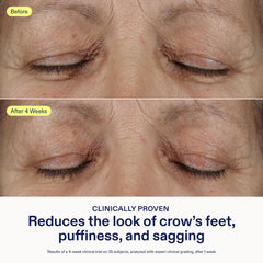 Applying Skinfix under-eye treatment to reduce puffiness and support the eye area.