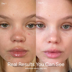 Solawave Bye Acne 3-minute session for quick skin refresh