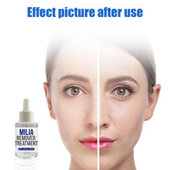 Sylvirene Milia Remover Serum facial application supports clearer pores.