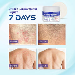 TAGRID Folliculitis Cream dispensing pump illustrates easy, mess-free use.