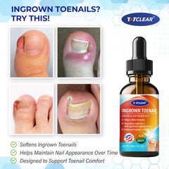 TOTCLEAR ingrown toenail relief drops bottle for easy, mess-free application