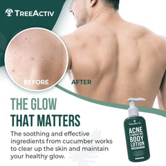 TreeActiv Acne Eliminating Body Lotion back view shows lightweight, fast-absorbing formula.