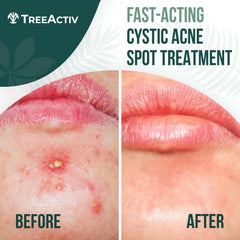 TreeActiv cystic acne spot treatment dab on spot demonstrates quick, targeted relief for cystic blemishes.