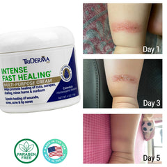 TriDerma Intense Fast Healing Cream face application showing gentle use on sensitive skin