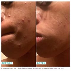 Urban Skin Rx Clear Skin Bar being applied to the face for double-action exfoliation and clarifying.