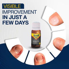 URIEL UPGRADED ingrown toenail-drops application for easy at-home relief